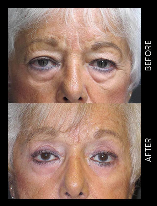Blepharoplasty Before & After
