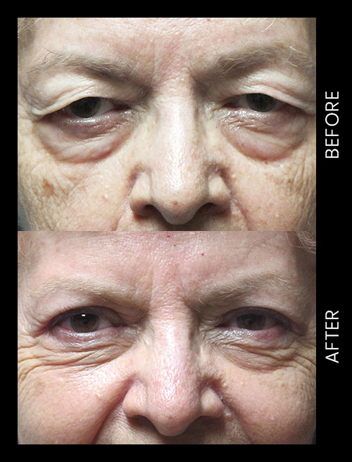 Blepharoplasty Before & After