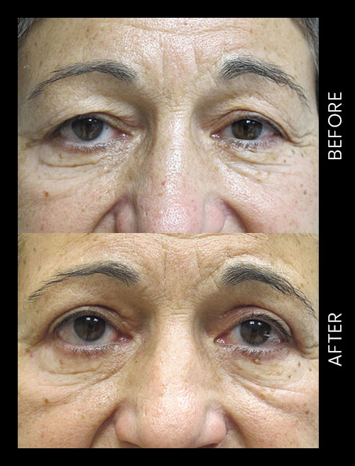 Blepharoplasty Before & After