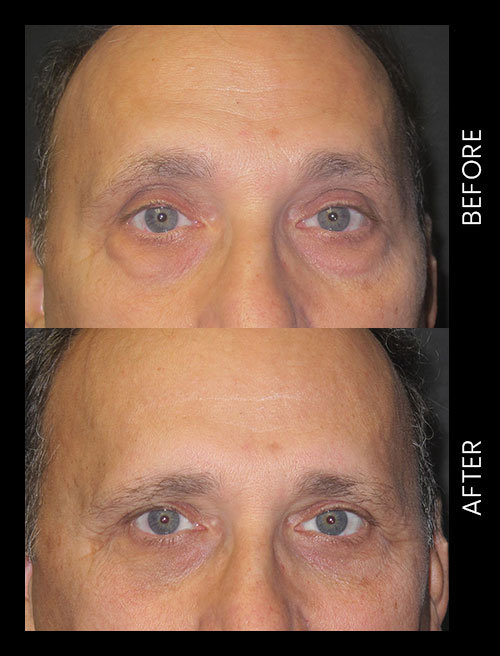 Blepharoplasty Before & After