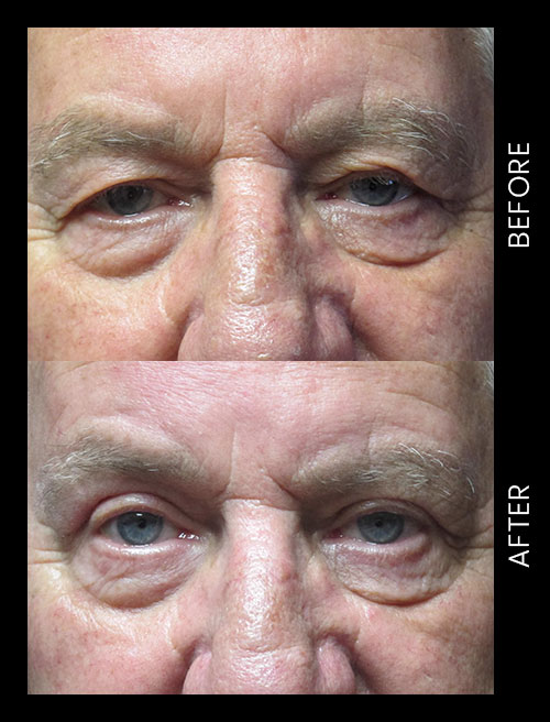 Blepharoplasty Before & After