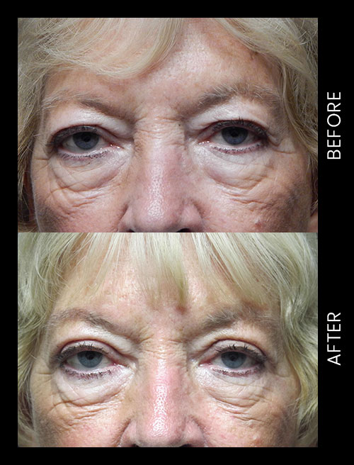 Blepharoplasty Before & After