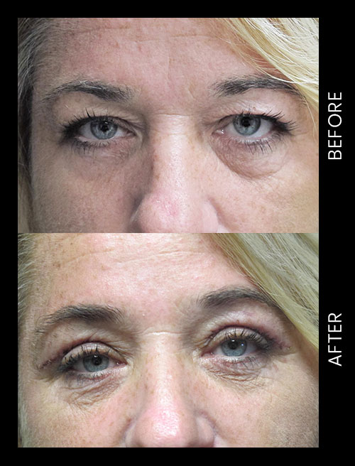 Blepharoplasty Before & After
