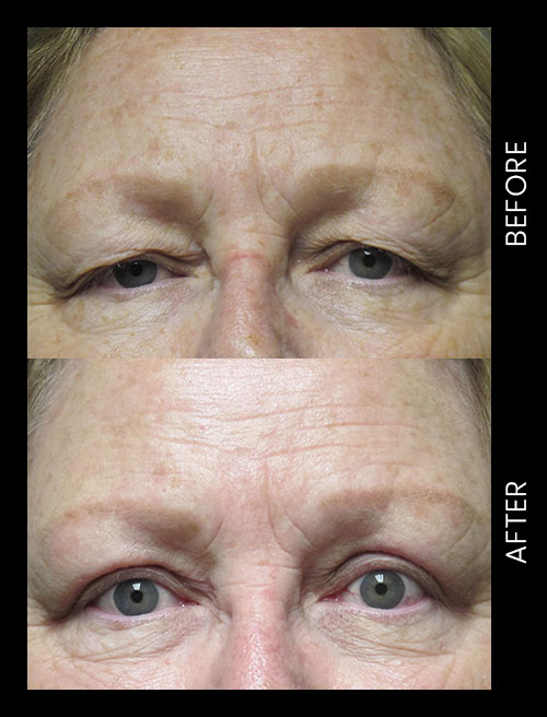 Blepharoplasty Before & After