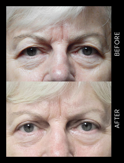 Blepharoplasty Before & After